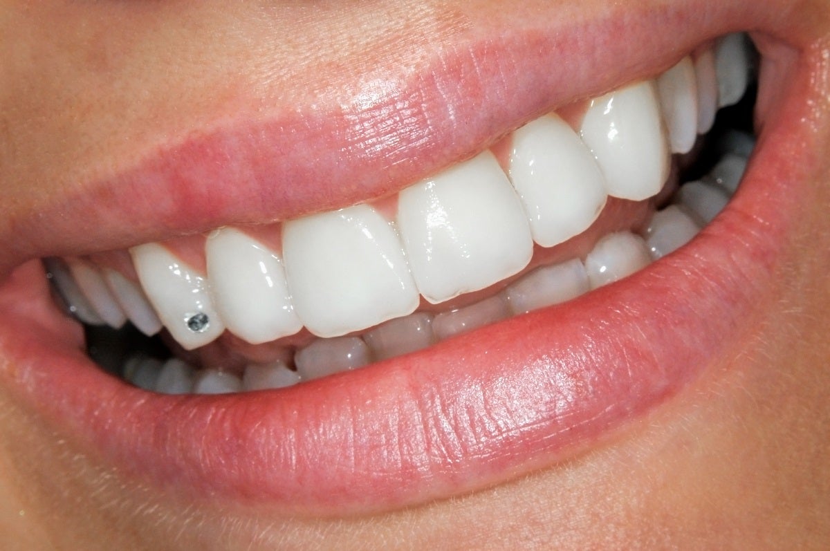Veneers are trending. According to some experts, however, the cost of a perfect smile is higher than those seeking the procedure might think.