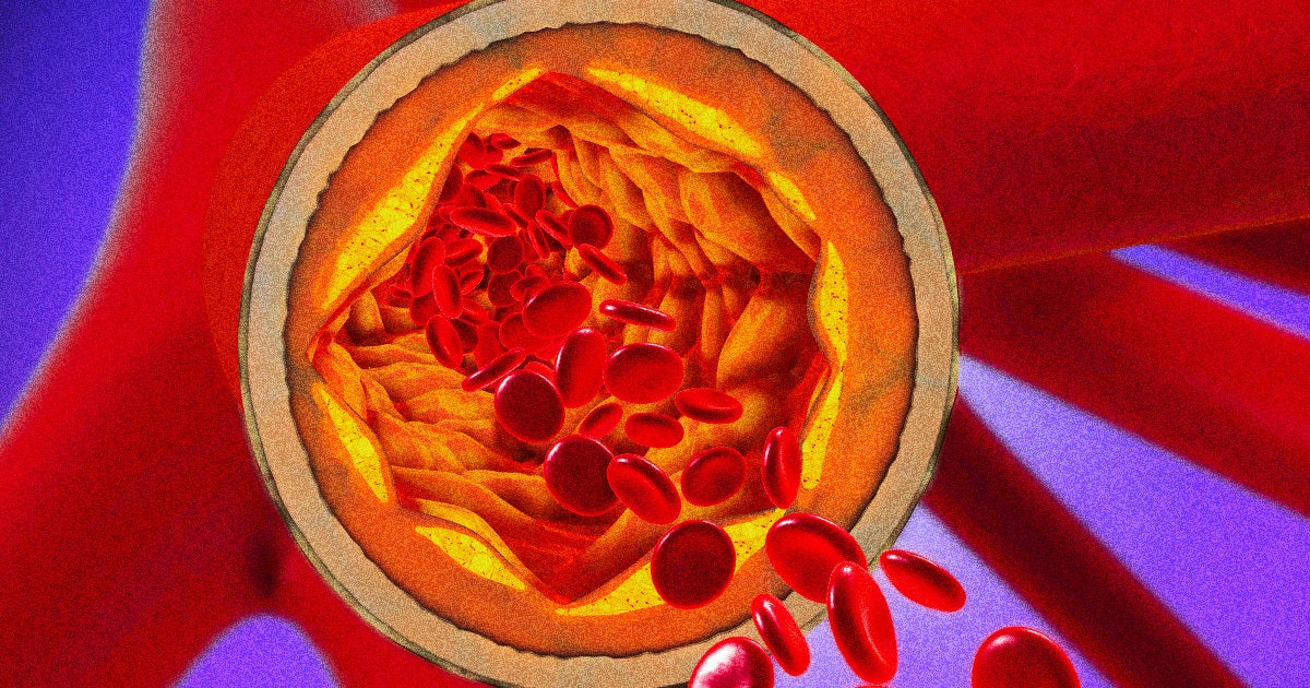 Researchers have reduced the level of bad cholesterol in human subjects after injecting them with an experimental gene editing treatment.
