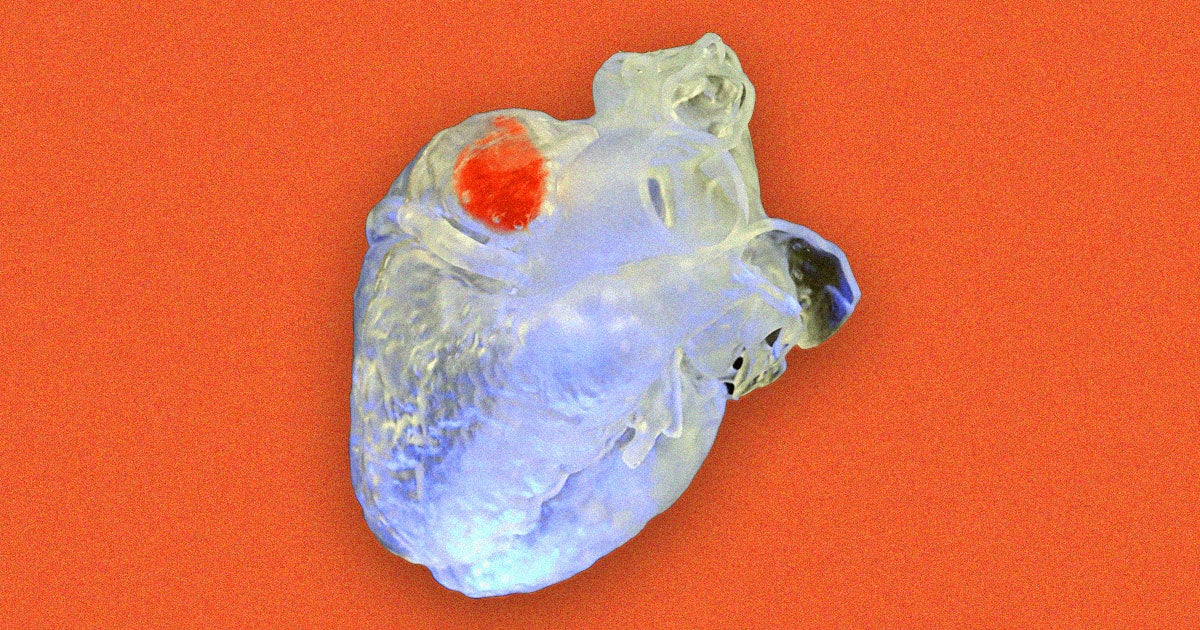 Researchers have developed a new way to 3D-print inside the human body using a special bioink and ultrasound waves.