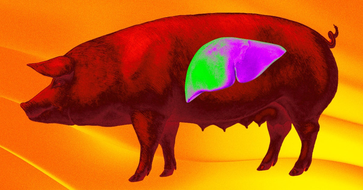 Doctors used a genetically-modified pig liver to successfully filter the human blood of a brain-dead patient.