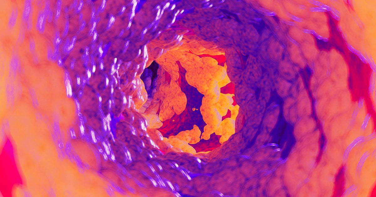 A new study came out in Nature Metabolism that suggests that eating excessive amount of protein is bad for your arteries.