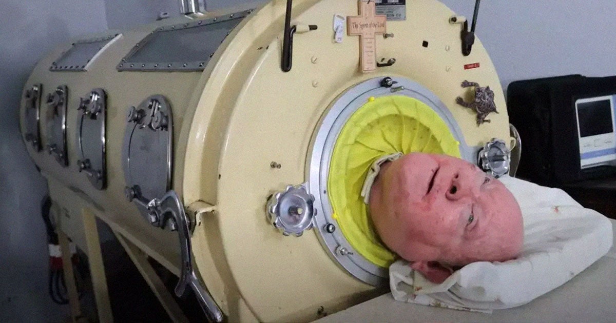 A 78-year-old man, who has been living inside an iron lung since surviving polio in the 1950s, has passed away. 
