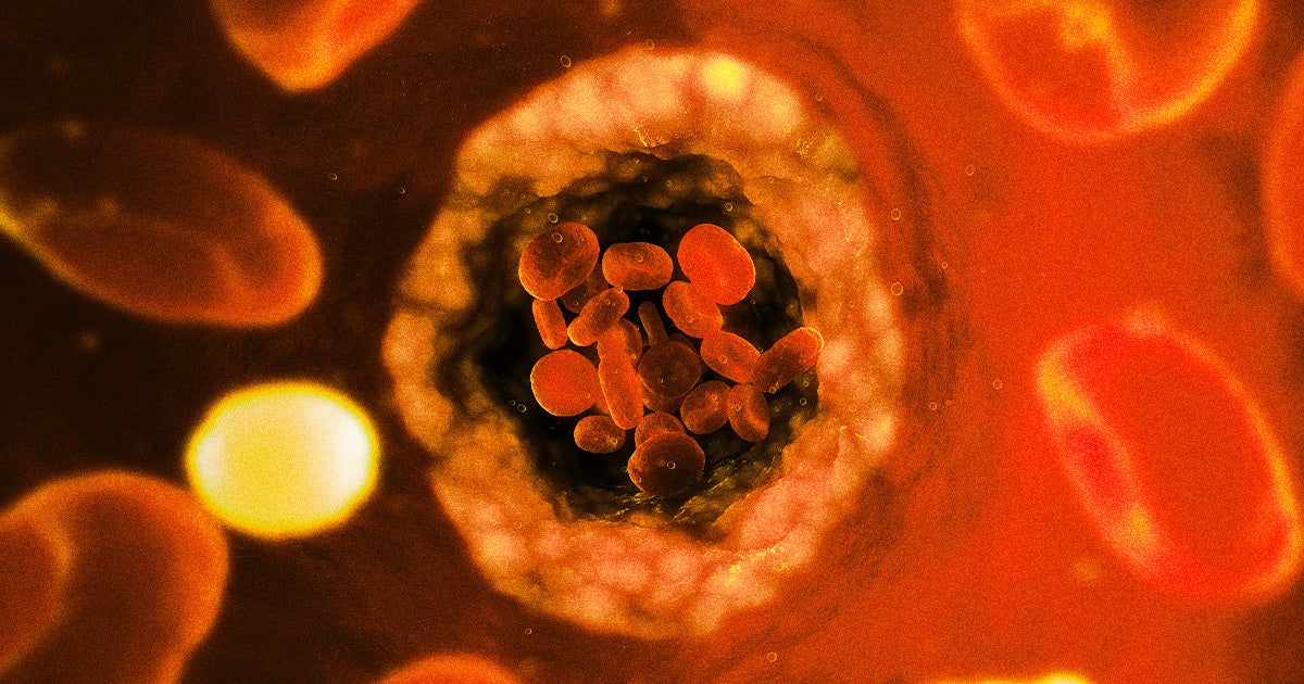 A new study linked the presence of microplastics in artery-clogging plaque to a higher risk of heart disease and even death.