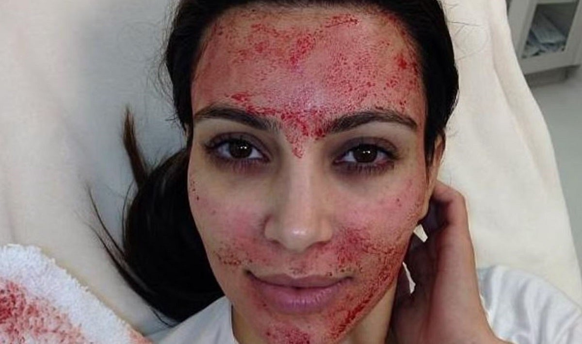At least three women were diagnosed with HIV after receiving a bloody "vampire facial" at an unlicensed New Mexico wellness spa.