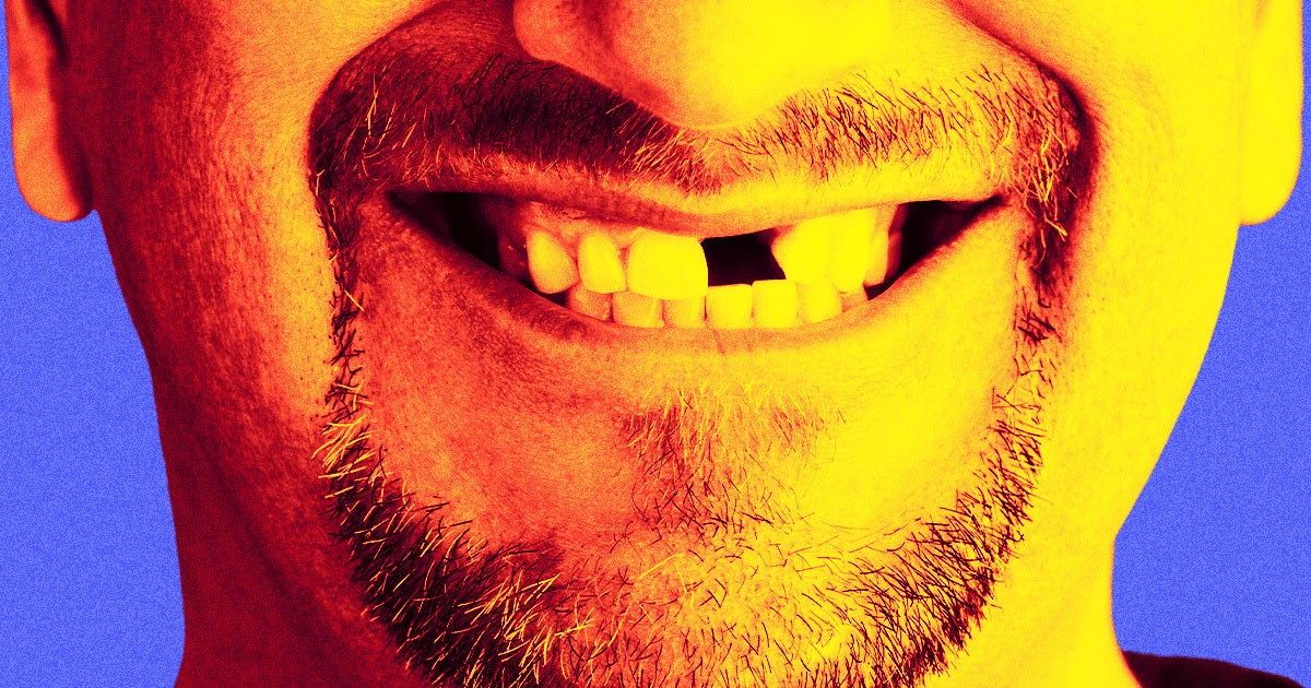 An Alaskan city removed fluoride from its drinking water like RFK wants to do for the whole country — and tooth decay surged.