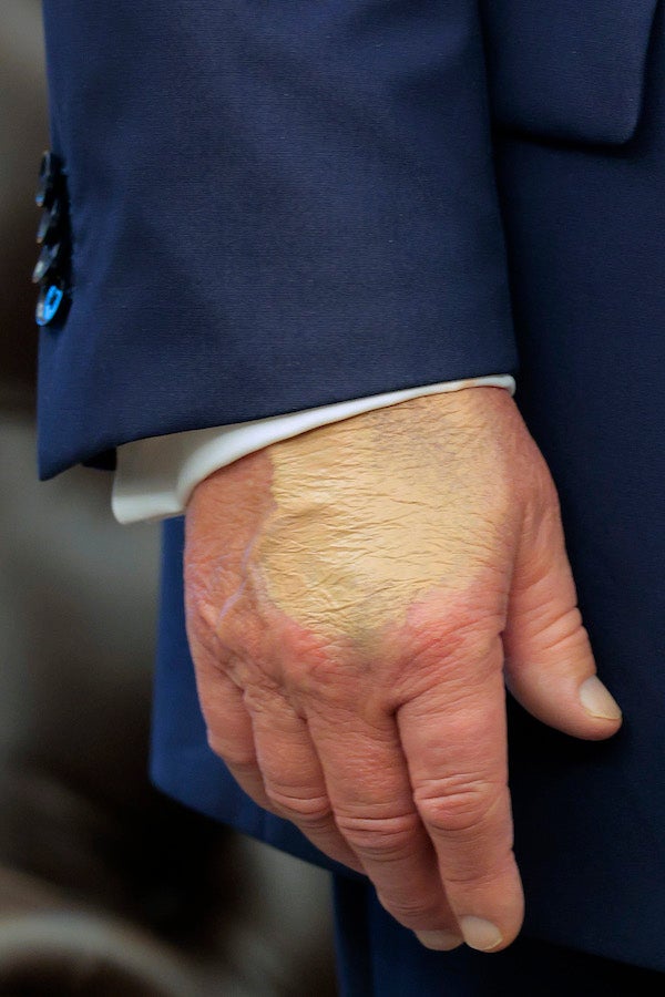 A close-up photo of president Donald Trump's right hand, which is partially covered in off-shade makeup. He wears a navy suit jacket with a white shirt peeking out. Image via Chip Somodevilla/Getty Images.